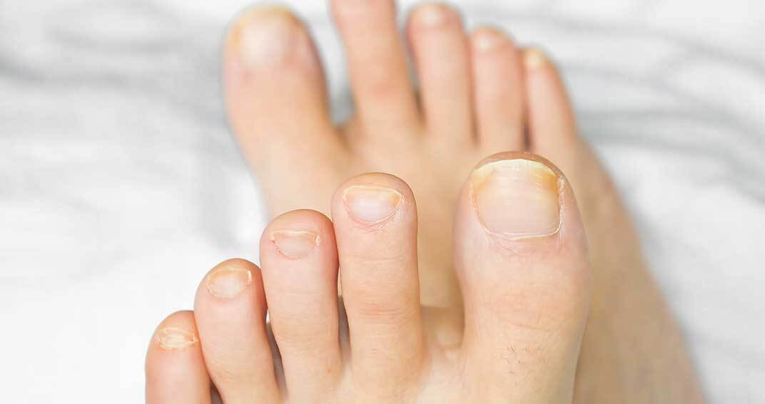 Comment prévenir les mycoses des pieds : conseils simples et pratiques