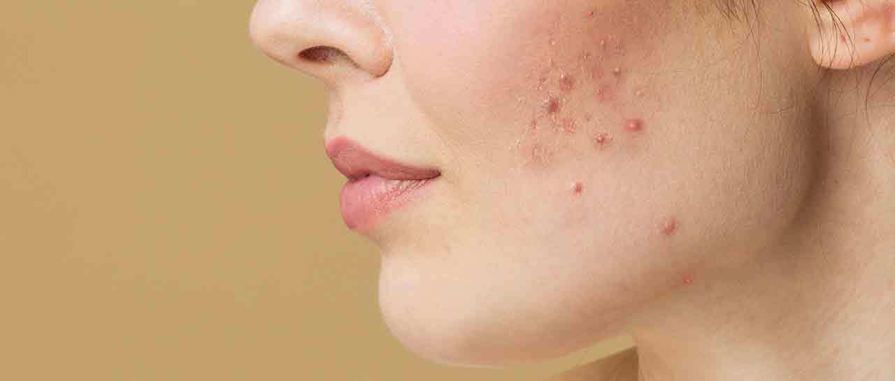 Des solutions pour traiter l'acné