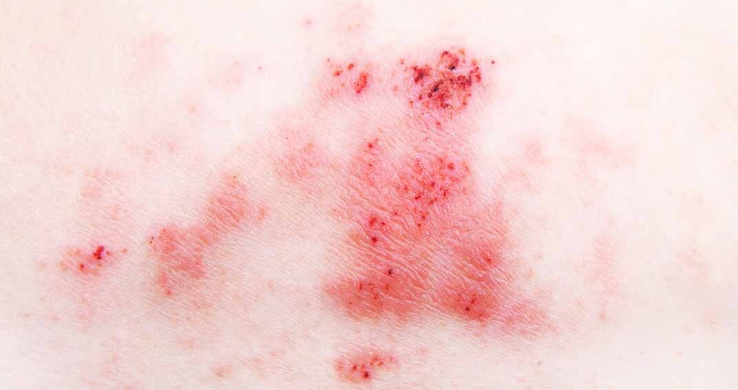 La dermatite atopique, une vraie maladie