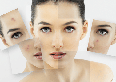 Les différents visages de l’acné