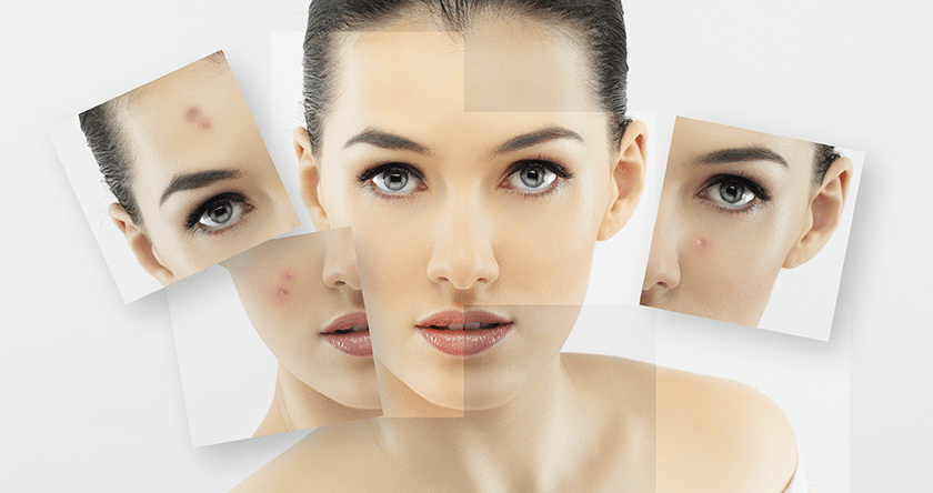 Les différents visages de l’acné