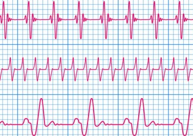 Que faut-il savoir sur l’électrocardiogramme ?