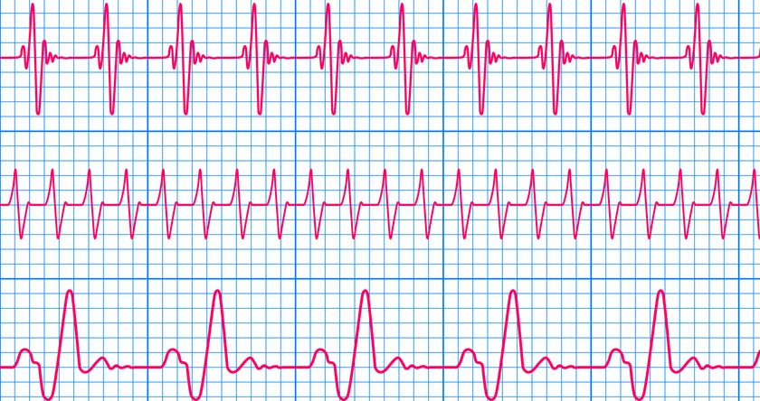 Que faut-il savoir sur l’électrocardiogramme ?