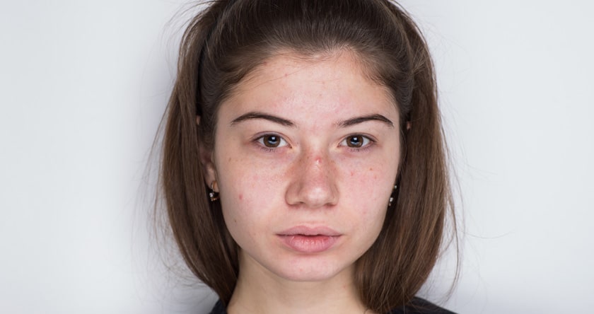 L’acné chez l’adolescent